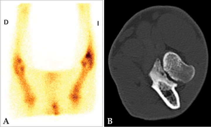 <p>Estudio de un paciente canino con dolor inespecífico en extremidad anterior izquierda. (<strong>A</strong>) Gammagrafía ósea, adquisición en fase ósea 2 horas después de la administración de <sup>99m</sup>Tc-HDP, proyección ventral de las extremidades anteriores en las que se observa un foco con aumento de captación del radioisótopo en la región de la articulación del codo izquierdo, principalmente en la porción distal de la misma. La imagen es compatible con patología del proceso coronoides medial. (<strong>B</strong>) TC del codo izquierdo del mismo paciente, plano transversal en algoritmo hueso en el que se observa un área hipoatenuante en el coronoides medial sin línea de fractura evidente, compatible con condromalacia y enfermedad de coronoides medial sin presencia de fragmentos. La gammagrafía permitió en este caso localizar la articulación con patología (codo) que es la que se examinó con la TC.</p>