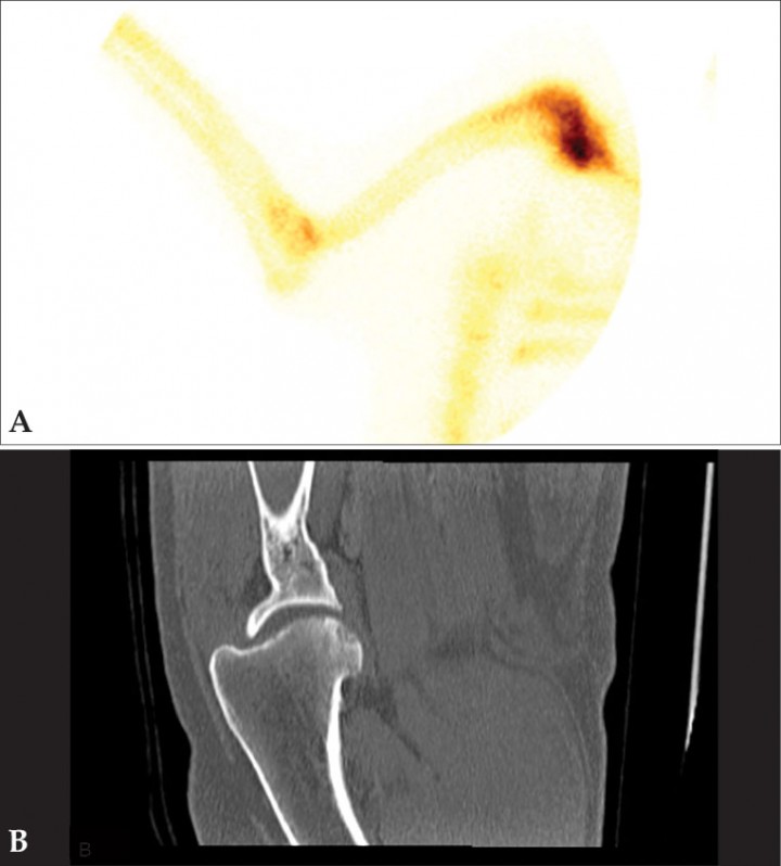 <p>Estudio por imagen de un perro con cojera de la extremidad anterior izquierda. (<strong>A</strong>) Gammagrafía en fase ósea en la que se aprecia aumento de captación de <sup>99m</sup>Tc-HDP en la articulación escapulohumeral. (<strong>B</strong>) Reconstrucción sagital de TC de hombro izquierdo en algoritmo hueso con pequeños defectos subcondrales en la superficie caudal de la cabeza humeral compatible con osteocondrosis (TC cortesía de ARS Veterinaria). La gammagrafía permitió en este perro de raza grande (montaña del Pirineo) localizar la articulación que presentaba patología para realizar la TC solo de la región anatómica afectada.</p>