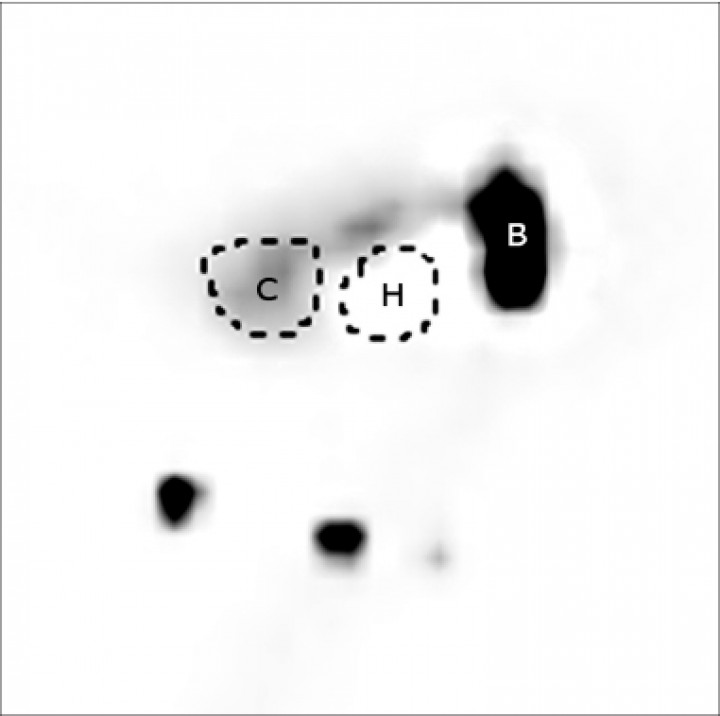 <p>Gammagrafía de una perra con sospecha de <em>shunt</em> portosistémico. Imagen sumatoria de la adquisición dinámica de los primeros 3 minutos después de inyectar una dosis de 1 mCi en el parénquima esplénico (B). Se observa la presencia del radiofármaco antes en el corazón (C) que en el hígado (H). Los dos puntos en la parte inferior de la imagen son los marcadores con radiofármaco que señalan la localización del hígado y del corazón y que sirven de orientación durante la fase dinámica. La imagen confirma la presencia de un <em>shunt</em> extrahepático.</p>