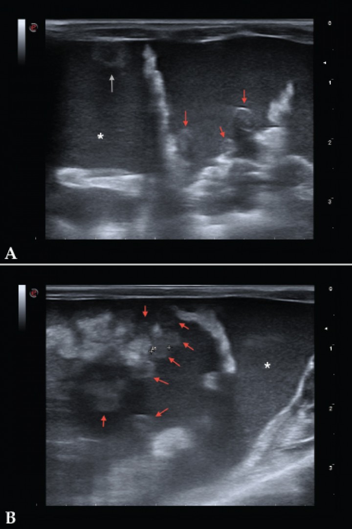 <p>Imágenes ecográficas de la cavidad abdominal. Se observan varios nódulos de 3 mm aproximadamente, hipoecoicos (algunos se observan más ecogénicos que otros) y de superficie levemente irregular; uno localizado en la superficie de la pared ventral peritoneal (flecha gris) y otros en omento (flechas rojas). Abundante líquido libre abdominal con abundantes ecos internos (asterisco).</p>