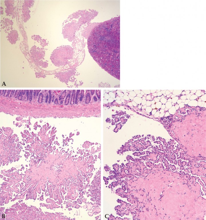 <p>(<strong>A</strong>) Crecimientos papilares de células mesoteliales neoplásicas en el peritoneo visceral del bazo (Hematoxilina-eosina, x5,76). (<strong>B</strong>) Intestino (Hematoxilina-eosina, x14,4). (<strong>C</strong>) Mesotelioma con formaciones papilares adherido a tejido adiposo y mesenterio con material eosinófilo intratumoral compatible con amiloide (Hematoxilina-eosina, x28,8).</p>