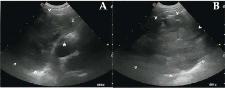 <div>
<p>(<strong>A</strong> y <strong>B</strong>) Cortes longitudinales de la ecografía torácica a diferentes niveles de tórax craneal. Se observa una gran masa heterogénea de aspecto glandular (puntas de flecha) en contacto con el polo craneal del corazón (*).</p>
</div>