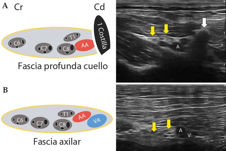 <p>Imágenes ecográficas del plexo braquial con su correspondiente esquema anatómico. (<strong>A</strong>) Abordaje subescalénico. Se identifica primera costilla (flecha blanca), con su sombra acústica característica y la arteria axilar (A). Cranealmente a las mismas aparecen las raíces nerviosas de interés, visualizadas como círculos hipoecoicos rodeados de un halo hiperecogénico (flechas amarillas), situadas dentro de la fascia profunda del cuello. (<strong>B</strong>) Abordaje axilar. Como una estructura doble hipoecogénica se identifican la vena (V), parcialmente colapsada, y la arteria axilar (A). Cranealmente a las mismas aparecen las raíces nerviosas de interés con su disposición característica en panel de abeja (flechas amarillas) rodeadas por la fascia axilar. Cd: caudal, Cr: craneal, AA: arterial axilar, VA: vena axilar (ver Vídeos 1 y 2).</p>