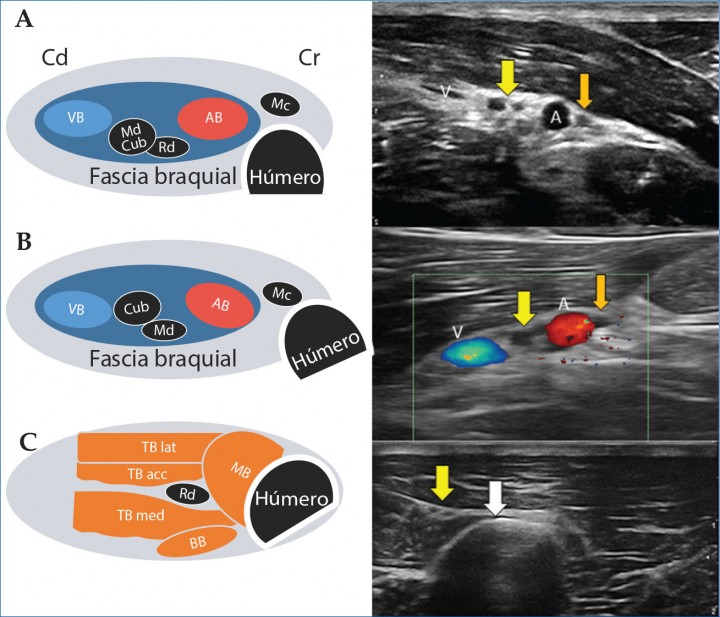 <p>Imágenes ecográficas de diversos bloqueos a nivel humeral con su correspondiente esquema anatómico. (<strong>A</strong>) Bloqueo de los nervios musculocutáneo, radial y tronco mediano-cubital, a nivel humeral proximal (RUMM proximal). Se identifican la vena (V), parcialmente colapsada, y la arteria braquial (A). Entre los vasos se aprecia el tronco mediano-cubital (más grande) y el nervio radial (flecha amarilla). Fuera de la fascia braquial y craneal a la arteria se sitúa el nervio musculocutáneo (flecha naranja). (<strong>B</strong>) Bloqueo de los nervios musculocutáneo, mediano y cubital, a nivel humeral medio. Entre la vena (V) y arteria (A) braquial, localizadas mediante Doppler, se sitúan los nervios mediano y cubital (flecha amarilla). El nervio musculocutáneo (flecha naranja) está fuera de la fascia y craneal a la arteria. (<strong>C</strong>) Bloqueo del nervio radial a nivel humeral medio. Caudalmente al húmero (flecha blanca) el nervio radial se identifica como una estructura anecoica rodeada de un halo hiperecogénico ovalado, dispuesta entre los vientres del tríceps braquial. Cd: caudal, Cr: craneal, VB: vena braquial, Md: nervio mediano, Cub: nervio cubital, Rd: nervio radial, AB: arteria braquial, Mc: nervio musculocutáneo, TB lat: músculo tríceps braquial (cabeza lateral), MB: músculo braquial, TB acc: músculo tríceps braquial (cabeza accesoria), TB med: músculo tríceps braquial (cabeza medial), BB: músculo bíceps braquial (ver Vídeo 3).</p>