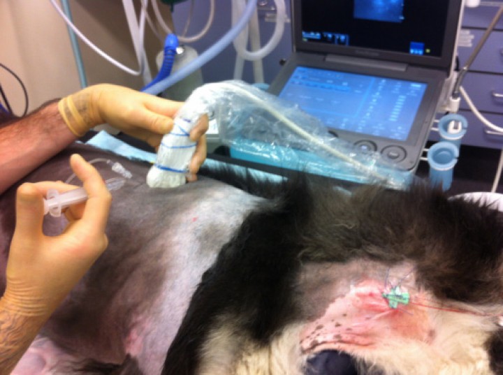 <p>Imagen que muestra la posición del transductor y la aguja para el bloqueo paravertebral torácico.</p>