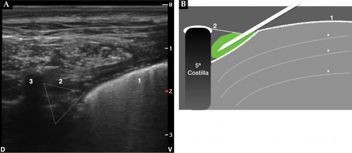 <p>(<strong>A</strong>) Imagen ecográfica del espacio paravertebral torácico. Pleura (1), ligamento costotransverso (2), proceso transverso (3), espacio paravertebral torácico (triángulo), D: dorsal, V: ventral. (<strong>B</strong>) Imagen esquemática de la posición de la aguja y la distribución del anestésico local. La pleura se desplaza ventralmente durante la administración del anestésico. Pleura (1), ligamento costocondral (2), sombra acústica del proceso transverso de la 5ª costilla y líneas A del pulmón (*) (ver Vídeo 4).</p>