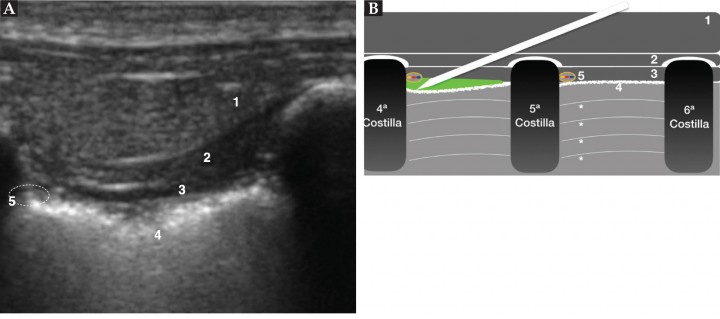 <p>(<strong>A</strong>) Imagen ecográfica del bloqueo intercostal a nivel de T5. Músculo serrato ventral (1), músculo intercostal externo (2), músculo intercostal interno (3), pleura (4), localización del paquete vasculonervioso con el nervio intercostal (5), zona de administración del anestésico (círculo punteado). (<strong>B</strong>) Imagen esquemática del bloqueo intercostal. La aguja se sitúa caudal a la costilla y se muestra el desplazamiento ventral de la pleura al inyectar el anestésico. Músculo serrato ventral (1), músculo intercostal externo (2), músculo intercostal interno (3), pleura (4), paquete vasculonervioso (5; amarillo: nervio intercostal, rojo: arteria intercostal, azul: vena homónima), sombra acústica de las costillas 4ª-5ª-6ª y líneas A del pulmón (*) (ver Vídeo 5).</p>