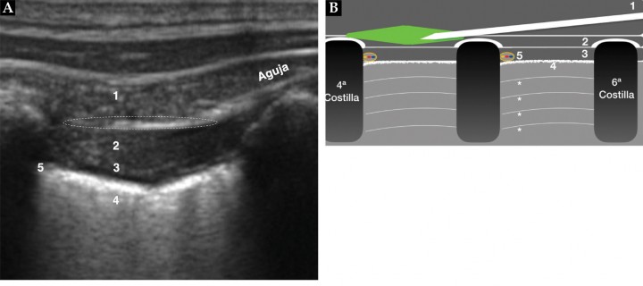 <p>(<strong>A</strong>) Imagen ecográfica del bloqueo del serrato a nivel de T5. Músculo serrato ventral (1), músculo intercostal externo (2), músculo intercostal interno (3), pleura (4), localización del paquete vasculonervioso con el nervio intercostal (5), zona de administración del anestésico correspondiente a la fascia entre músculo serrato y músculo intercostal externo (círculo punteado). (<strong>B</strong>) Imagen esquemática del bloqueo del serrato. La aguja se sitúa en la fascia entre los músculos serrato ventral e intercostal externo. La administración del anestésico producirá una burbuja de anestésico que separará perfectamente ambos músculos y pasará por encima de las costillas a los demás espacios intercostales. Músculo serrato ventral (1), músculo intercostal externo (2), músculo intercostal externo (3), pleura (4), paquete vasculonervioso (5), sombra acústica de las costillas 4ª-5ª-6ª y líneas A del pulmón (*) (ver Vídeo 6).</p>
