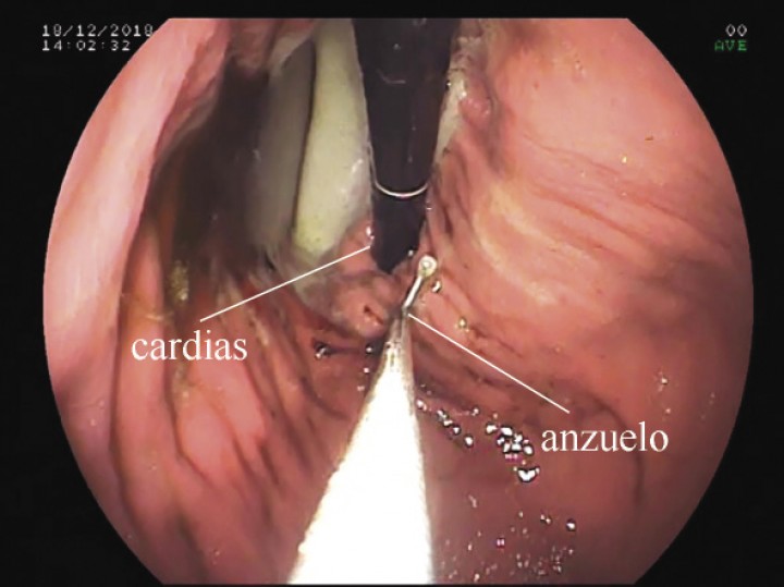 <p>Imagen endoscópica en retroflexión en la que se aprecia el anzuelo profundamente clavado en curvatura menor, en el cuerpo del estómago, muy próximo a la porción cardial.</p>