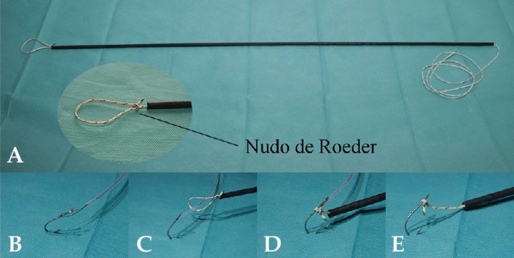 <p>(<strong>A</strong>) Anudador extracorpóreo con detalle del lazo con nudo corredizo de Roeder. (<strong>B</strong>) Paso del asa de polipectomía por el anzuelo. (<strong>C</strong>) Paso de la linea de pesca. (<strong>D</strong>) Cierre del nudo sobre el anzuelo. (<strong>E</strong>) Retirada del asa y tubo anudador (ver Vídeo 1).</p>