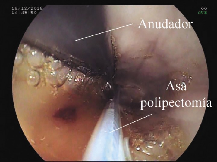 <p>Inserción del anudador bajo visión endoscópica. La funda de teflón del asa de polipectomía, introducida previamente, sirve de guía para dirigir el nudo.</p>