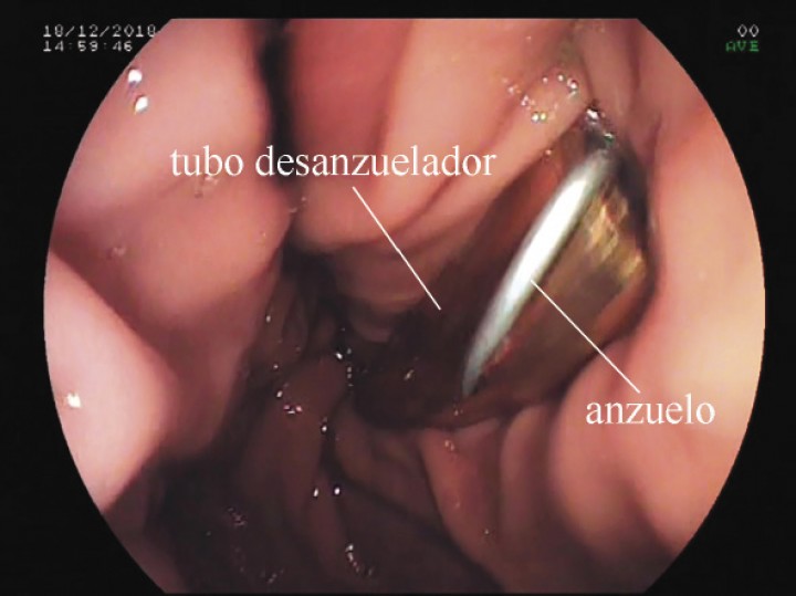 <p>Desanzuelado. Una vez introducido el anzuelo con ayuda del sedal en el tubo desanzuelador, con un impulso en dirección aboral se desclava de la mucosa (ver Vídeo 3).</p>