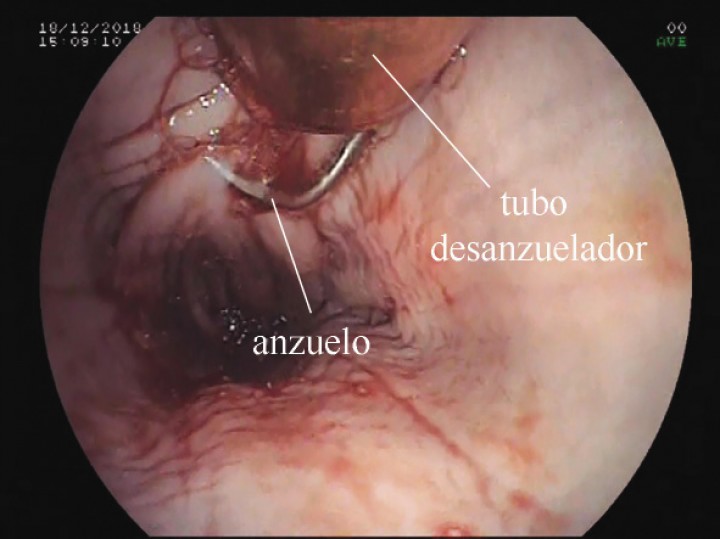 <p>Extracción. La maniobra de extracción requiere movimientos lentos para no clavar de nuevo la punta del anzuelo. Los movimientos del extremo distal y la insuflación ayudan al pasar por los esfínteres esofágicos (ver Vídeo 4).</p>