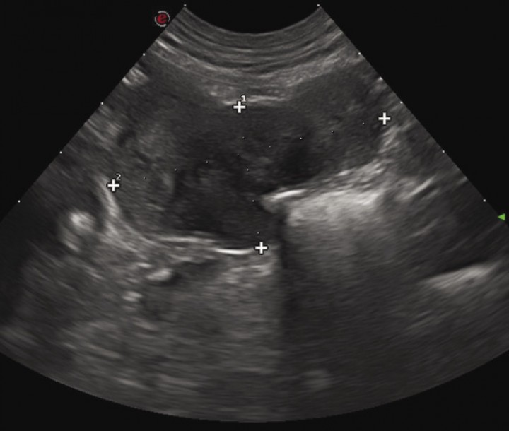 <div>
<div class=\"Basic-Text-Frame\">
<p>Ultrasound appearance of one of the GIST located on cecum.</p>
</div>
</div>