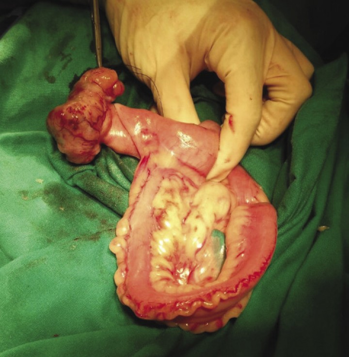 <p>Macroscopic aspect of the GIST showed in Figure 1.</p>