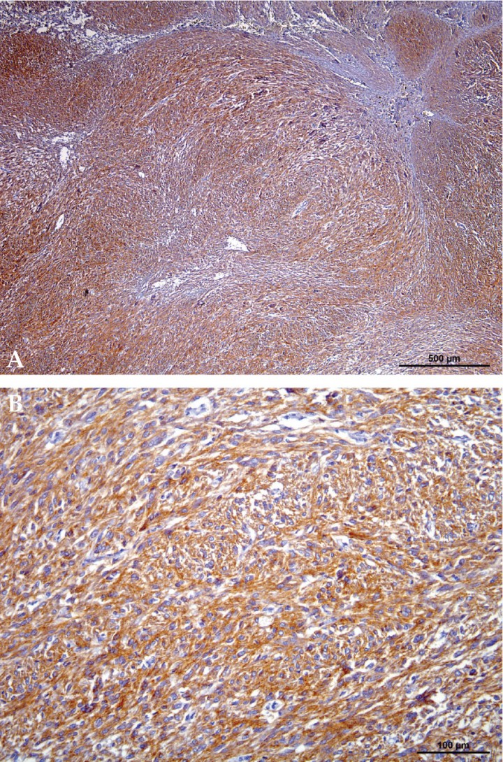 <p>Immunohistochemistry c-kit. (<strong>A</strong>) Histophatological appearance of one GIST. It shows marked and diffuse positive immunohistochemical staining for c-kit (CD117), x40. (<strong>B</strong>) Closed image x400.</p>