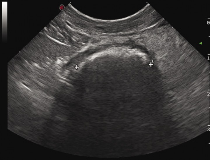 <p>Imagen ecográfica del asa intestinal con presencia de una estructura hiperecogénica con marcada sombra acústica en su interior.</p>