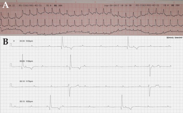 <p>(<strong>A</strong>) Taquicardia por alteración de la conducción eléctrica. (<strong>B</strong>) Bloqueo auriculoventricular por alteración de la conducción eléctrica.</p>