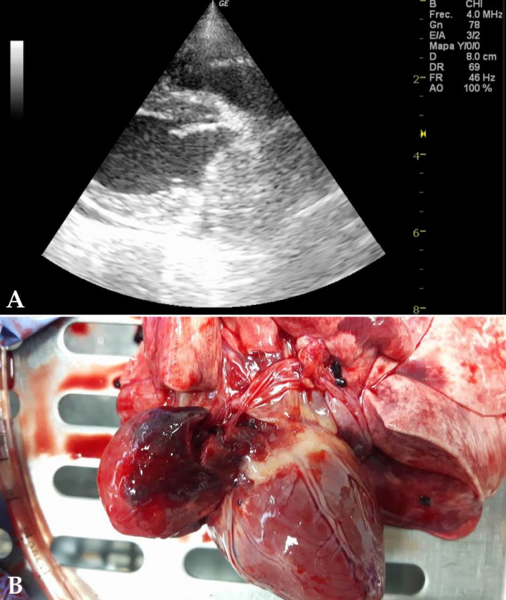 <div class=\"Basic-Text-Frame\">
<p>(<strong>A</strong>) Ecocardiografía en corte paraesternal derecho, eje largo, cuatro cámaras. Imagen compatible con masa en atrio derecho (entre flechas). (<strong>B</strong>) Imagen macroscópica donde se aprecia la visualización de masa en aurícula izquierda <em>post mortem</em>.</p>
</div>

<div>
<div class=\"frame-2\"> </div>
</div>