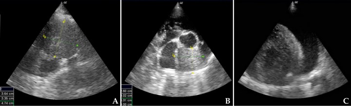 <p>(<strong>A</strong>) Ecocardiografía en corte paraesternal derecho eje corto, base cardiaca-aorta compatible con masa en atrio derecho. (<strong>B</strong>) Ecocardiografía en corte paraesternal derecho eje corto, base cardiaca-aorta compatible con tumor de base cardiaca. (<strong>C</strong>) Ecocardiografía en corte paraesternal derecho eje corto, ventrículo izquierdo compatible con derrame pericárdico.</p>