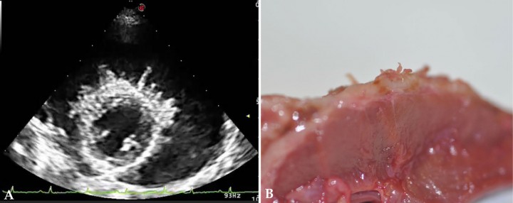 <p>(<strong>A</strong>) Ecocardiografía en eje paraesternal derecho, eje corto, ventrículo izquierdo, compatible con derrame pericárdico y mesotelioma. (<strong>B</strong>) Detalle <em>post mortem</em> de mesotelioma.</p>