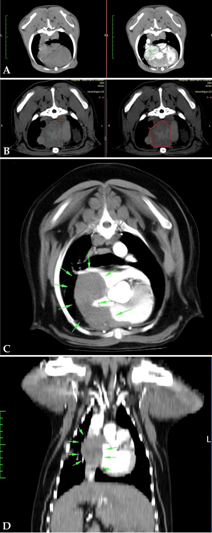 <p>Imágenes de TAC. (<strong>A</strong>) Plano transversal tórax ventana tejido blando, precontraste (izquierda) y postcontraste (derecha). Imagen compatible con tumor de base cardiaca (entre flechas) con captación de contraste. (<strong>B</strong>) Plano transversal tórax ventana tejido blando, postcontraste (izquierda) y precontraste (derecha). Imagen compatible con tumor de base cardiaca (silueta roja) sin captación de contraste. (<strong>C</strong>) Plano transversal tórax ventana tejido blando, postcontraste. Imagen compatible con tumor de atrio derecho (entre flechas) sin captación de contraste. (<strong>D</strong>) Mismo paciente que imagen C pero en un plano dorsal. Imagen compatible con tumor de atrio derecho sin captación de contraste.</p>
