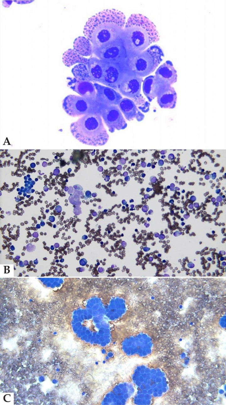 <div>
<p>(<strong>A</strong>) Citología de líquido pericárdico en una gata con carcinomatosis. (<strong>B</strong>) Citología de líquido pericárdico compatible con linfoma. (<strong>C</strong>) Citología de líquido pericárdico compatible con mesotelioma (confirmado con anatomía patológica). En las tres imágenes: tinción May-GrünWald Giemsa. 400X.</p>
</div>