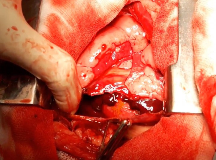 <p>Imagen intraquirúrgica de una pericardiectomía.</p>