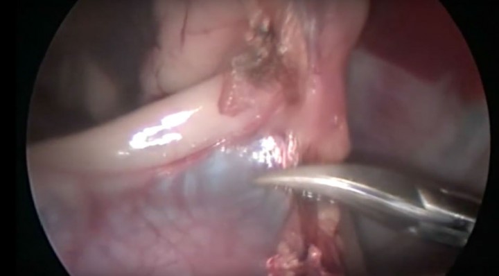 <p>Pericardiectomía por toracoscopia.</p>