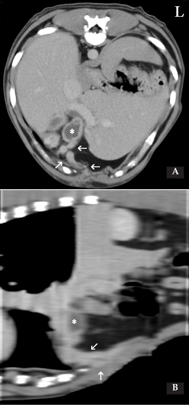 <p>Caso 1. Imágenes de Tomografía Computarizada (TC) en ventana de tejido blando, post-contraste. (<strong>A</strong>) Plano transversal. (<strong>B</strong>) Plano sagital. Se visualiza un engrosamiento de la pared abdominal; en su interior se observa una estructura tubular y tortuosa con un realce periférico homogéneo (109 UH) con un centro hipoatenuante que se corresponde a un trayecto fistuloso (flechas), el cual se origina caudal a la apófisis xifoides a nivel de la línea alba, y se extiende craneal y dorsal hasta el interior de la cavidad abdominal (flechas) para terminar adyacente a la vesícula biliar (*) que presenta la pared engrosada e irregular. L: Izquierdo.</p>