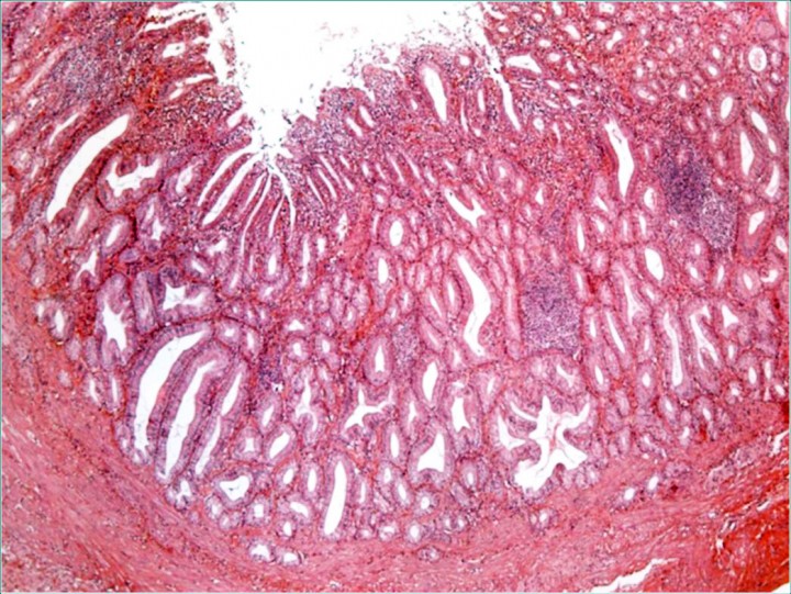 <p>Estudio histopatológico. Se evidencia un engrosamiento de la mucosa de la vesícula biliar con pérdida focal del epitelio superficial y proliferación de glándulas tubulares en la lámina propia con agregados foliculares linfoides. La túnica muscular estaba hipertrofiada y se observó fibrosis severa de la serosa con un infiltrado moderado, similar a la mucosa. Hematoxilina-Eosina, x50.</p>