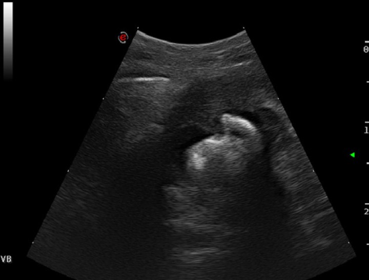 <p>Imagen ecográfica de la vesícula biliar. Se visualiza la pared engrosada con cálculos en su interior.</p>