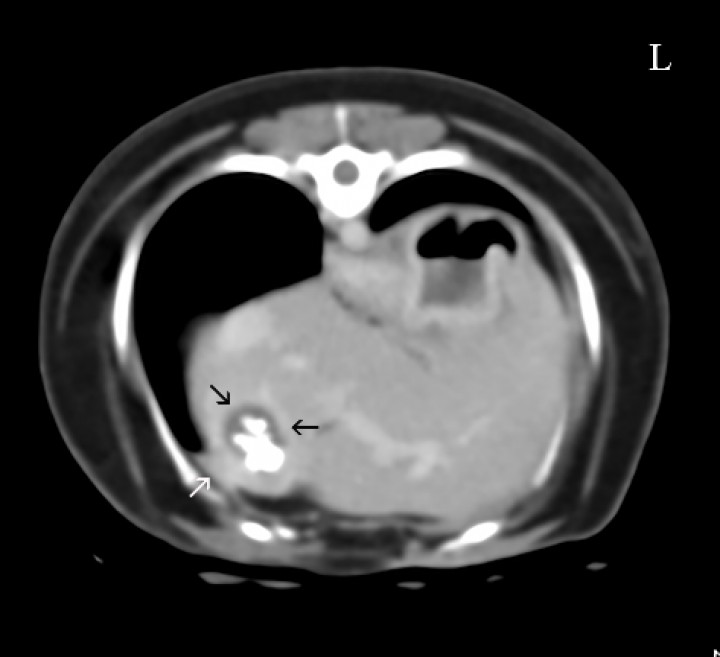 <p>Imagen de Tomografía Computarizada en ventana de tejido blando, post-contraste en plano transversal. Se visualizan cálculos en la vesícula biliar que ocupan prácticamente toda la luz y la pared engrosada (flechas negras); el lóbulo hepático presenta adherencias con la pared costal (fecha blanca). L: Izquierdo.</p>