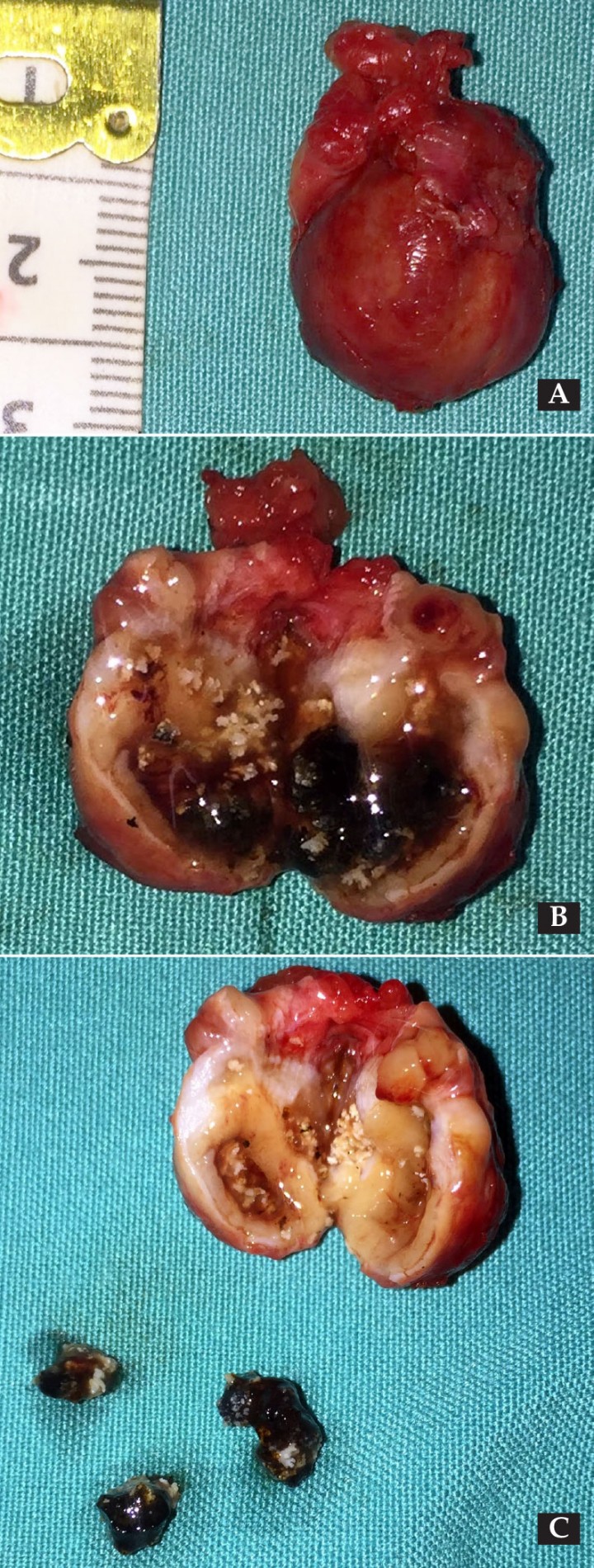 <p>Imágenes de la vesícula biliar tras la colescitectomía del Caso 2. (<strong>A</strong>) Se aprecia su coloración y consistencia anormal. (<strong>B</strong> y <strong>C</strong>) Incisión de la vesícula biliar. Se observa su pared engrosada y la presencia de cálculos en su interior.</p>
