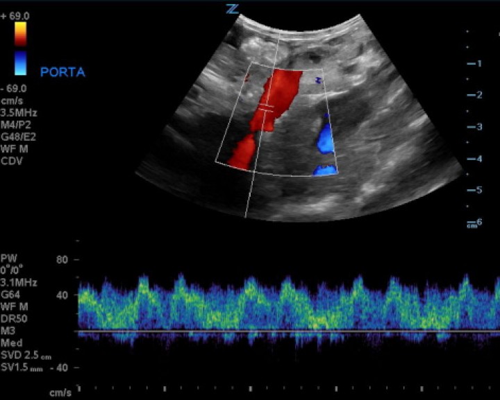 <p>Imagen ecográfica en un corte longitudinal de la paciente con Doppler color y pulsado. Se observa un flujo pulsátil e invertido (hepatógufo) de la vena porta principal.</p>