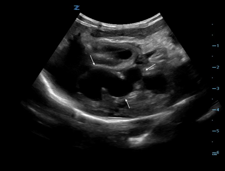 <div class=\"Basic-Text-Frame\">
<p>Imagen ecográfica en un corte transversal donde se observa una estructura tubular anecoica en el lóbulo izquierdo hepático en relación con la vena porta intrahepática (flechas).</p>
</div>