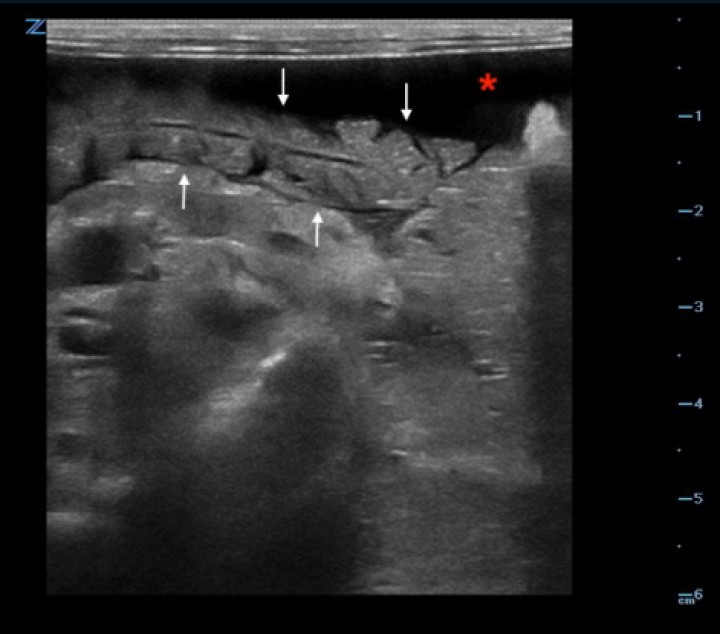 <p>Imagen ecográfica en un corte transversal de la paciente donde se observa el lóbulo pancreático derecho aumentado de volumen con presencia de estrías hipoecoicas compatible con una edematización de la glándula (flechas). Presencia de líquido libre abdominal (*).</p>