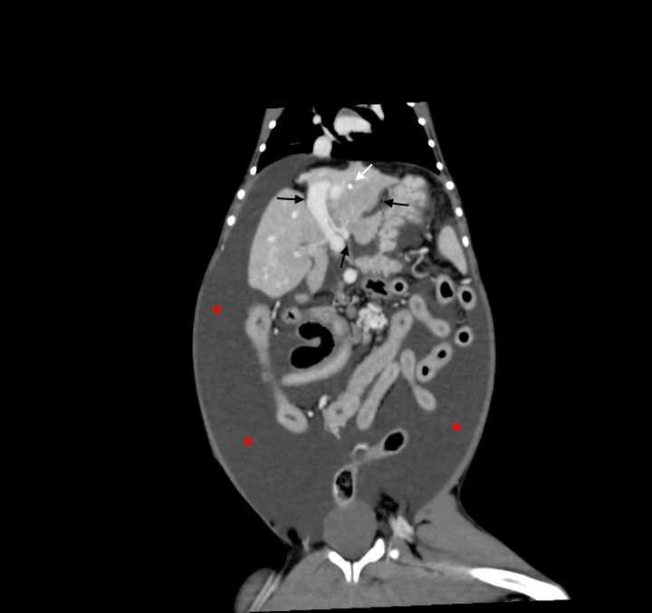 <p>Imagen de tomografía computarizada dorsal tras la administración de contraste intravenoso, ventana de tejido blando. Se observa una microhepatía asimétrica con los lóbulos hepáticos izquierdos de menor tamaño que los derechos (flechas negras) y foco de mineralización distrófica en el parénquima hepático (flecha blanca). Presencia de gran cantidad de líquido libre abdominal (*).</p>