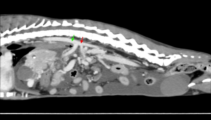 <p>Imagen de tomografía computarizada sagital tras la administración de contraste intravenoso, ventana de tejido blando. Se observa el tronco celíaco dilatado (flecha negra) con disminución del tamaño de la aorta abdominal caudal al mismo (flecha roja). Aorta abdominal craneal al tronco celíaco (flecha verde).</p>