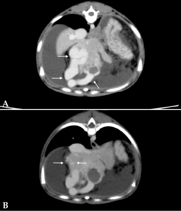 <div>
<div class=\"Basic-Text-Frame\">
<p>Imágenes de tomografía computarizada transversales tras la administración de contraste intravenoso, ventana de tejido blando. (<strong>A</strong>) Se observa la rama portal intrahepática en lóbulo medial izquierdo anormalmente dilatada y tortuosa (flechas). (<strong>B</strong>) Se aprecian vasos tortuosos (flechas) que drenan en la vena porta tortuosa y aumentada de tamaño.</p>
</div>
</div>