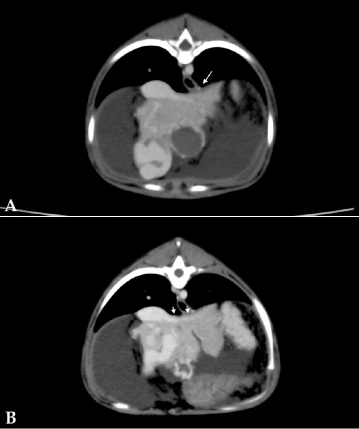<p>Imágenes de tomografía computarizada transversales tras la administración de contraste intravenoso, ventana de tejido blando. (<strong>A</strong>) Se observa la presencia de varices gastroesofágicas (flecha). (<strong>B</strong>) Se observa la presencia de varices gastrofrénicas (flechas).</p>