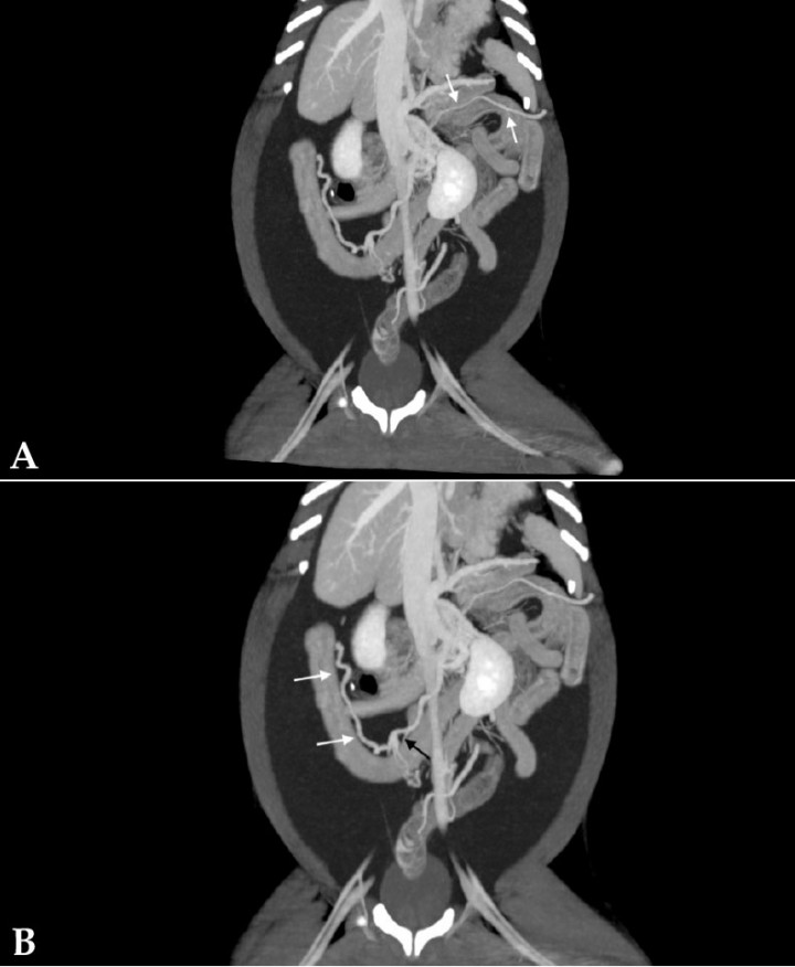 <p>Imágenes de tomografía computarizada dorsales tras la administración de contraste intravenoso, ventana de tejido blando y con proyección de máxima intensidad (MIP) con sumatorio de cortes. (<strong>A</strong>) Se observa un vaso anómalo a partir de la vena esplénica que se dirige hacia caudal y medial del riñón izquierdo (flechas). (<strong>B</strong>) Se aprecia un vaso anómalo a partir de la vena pancreaticoduodenal (flechas blancas) que desemboca en la vena mesentérica caudal (flecha negra).</p>