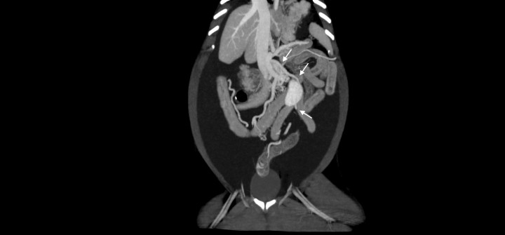 <p>Imagen de tomografía computarizada dorsal tras la administración de contraste intravenoso, ventana de tejido blando y con proyección de máxima intensidad (MIP) con sumatorio de cortes. Se observa a partir de la vena porta un vaso que se dirige hacia caudal por el lado izquierdo del abdomen y lateral al riñón izquierdo para dejar de ser visualizado a nivel del recto (flechas).</p>