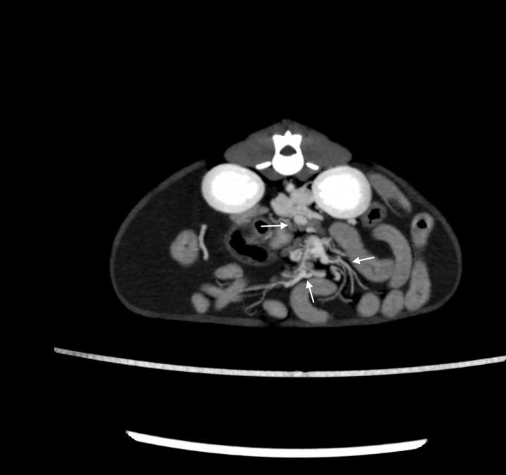 <p>Imagen tomográfica transversal tras la administración de contraste intravenoso, ventana de tejido blando y con proyección de máxima intensidad (MIP) con sumatorio de cortes. Se observan múltiples vasos tortuosos a nivel del abdomen central (flechas).</p>