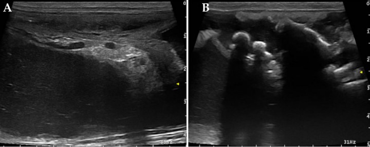 <div class=\"Basic-Text-Frame\">
<p>Imágenes ecográficas. (<strong>A</strong>) Se observa contenido uterino hipoecoico con marcada celularidad. (<strong>B</strong>) Se observan estructuras hiperecogénicas que generan sombra acústica compatibles con restos óseos intrauterinos.</p>
</div>