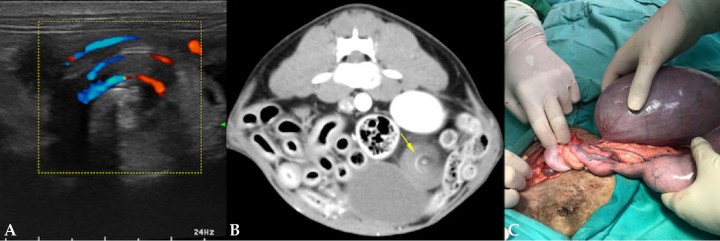 <p>(<strong>A</strong>) Ecografía Doppler con signo de remolino indicativo de torsión. (<strong>B</strong>) Tomografia computerizada con signo de remolino. (<strong>C</strong>) Imagen intraquirúrgica que evidencia la torsión del cuerno uterino izquierdo.</p>
