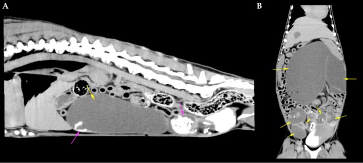 <p>Tomografías computerizadas prequirúrgicas del abdomen. (<strong>A</strong>) Corte sagital. (<strong>B</strong>) Corte dorsal. Se observa una gran distensión uterina con contenido líquido (flechas amarillas) y estructuras hiperatenuantes mineralizadas en su interior (flechas rosas).</p>