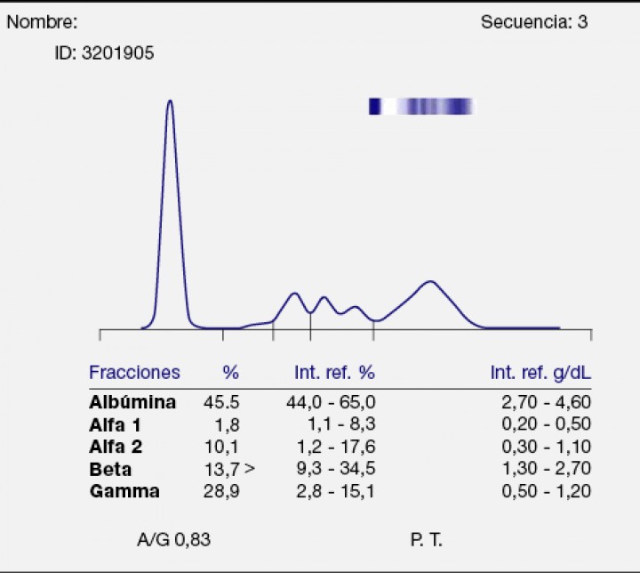 <p>Proteinograma de un gato Común Europeo con hiperproteinemia mantenida (10 g/dl) en tratamiento por la presencia de linfoma hepatoesplénico con quimioterapia. Este gato resultó positivo a calicivirus por PCR.</p>