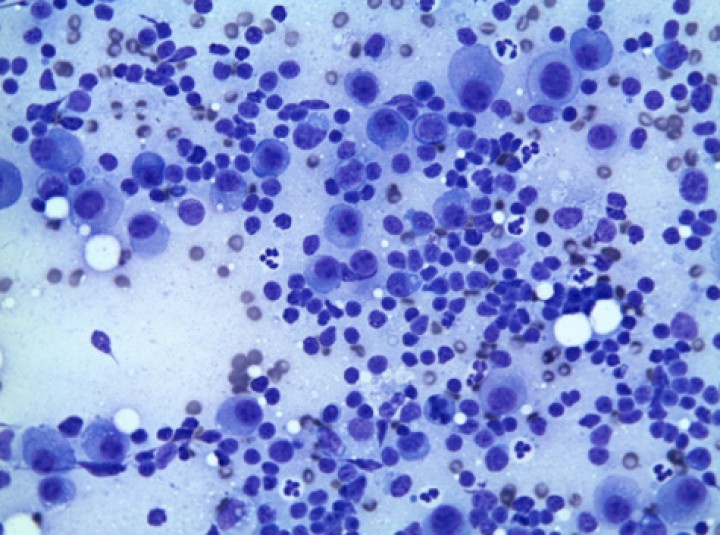 <p>Citología de la médula ósea de la gata de la Figura 2 que confirma la presencia de mieloma múltiple. La citología muestra elevada densidad celular compuesta por células redondas de 30-50 micras de diámetro de morfología plasmocitoide. El citoplasma se muestra densamente basófilo con una imagen perinuclear clara (Golgi) y el núcleo, redondeado, muestra un patrón formando múltiples grumos heterocromáticos. El plemorfismo es severo y se observan numerosas mitosis (>1 por campo-40X). Diff-quick, 40X. Imagen cedida por David Sardón, HCV UAX.</p>