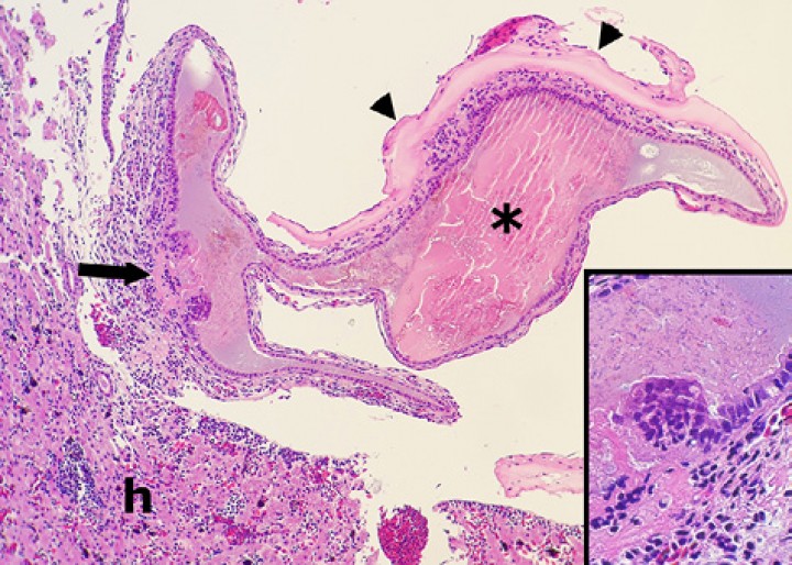 <p>Vesícula biliar; sapito balear (<em>Alytes muletensis</em>). Se observa colecistitis caracterizada por una zona de necrosis, erosión y depósito de fibrina en la mucosa (flecha) con depósito de exudado proteináceo sobre la serosa visceral (cabezas de flecha). La bilis contiene un tapón de material biliar (asterisco). Hematoxilina-eosina, x120. Recuadro: la bilis adyacente al foco de necrosis-erosión contiene numerosas bacterias. Hematoxilina-eosina, x480. h: hígado.</p>